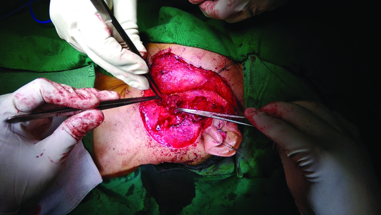 Figure 1. Parotid mass was found during total parotidectomy