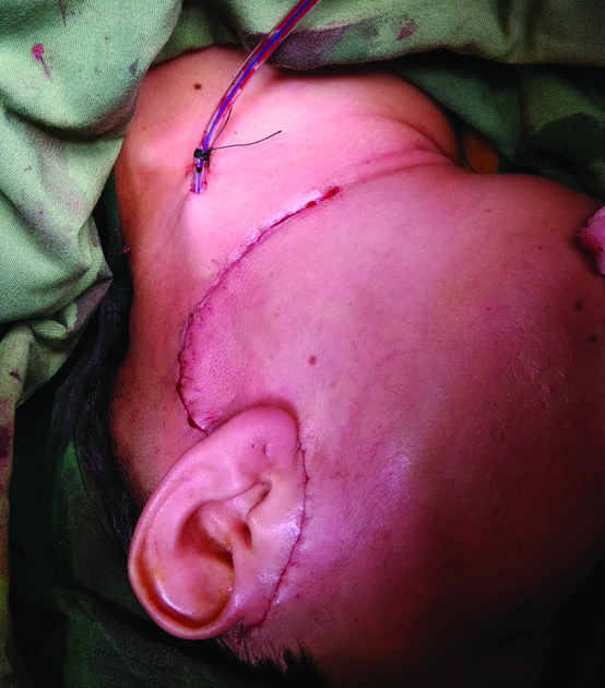 Figure 2. Post total thyroidectomy