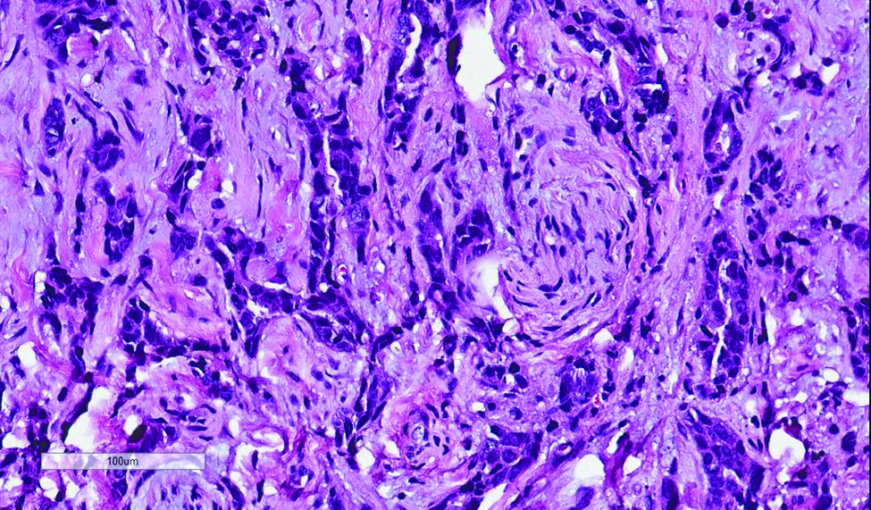 Figure 3. Tumor cells, some formed glandular structure, infiltrative in stroma (HE, 20x)