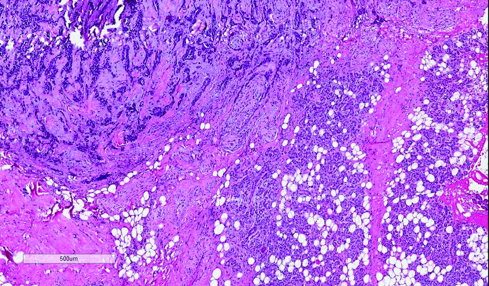 Figure 4. Tumor cell infiltrating some of salivary gland (HE, 4x)