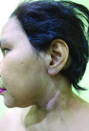 Figure 5. A month after radiotherapy
